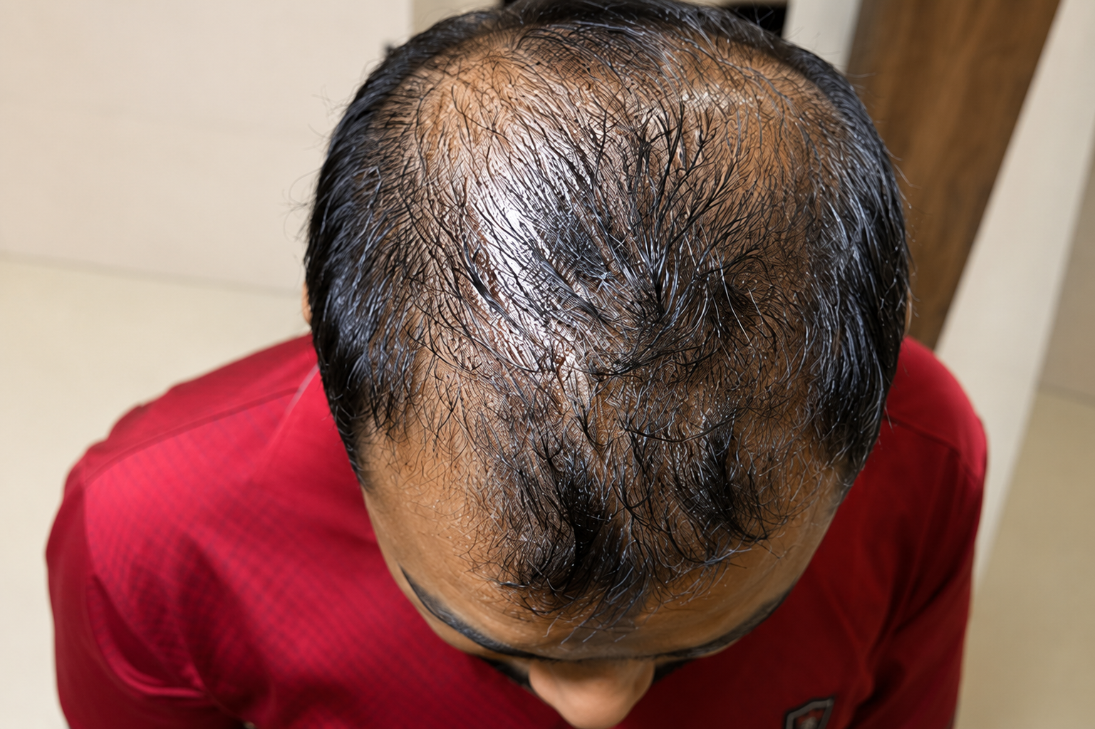Hair Fall Before
