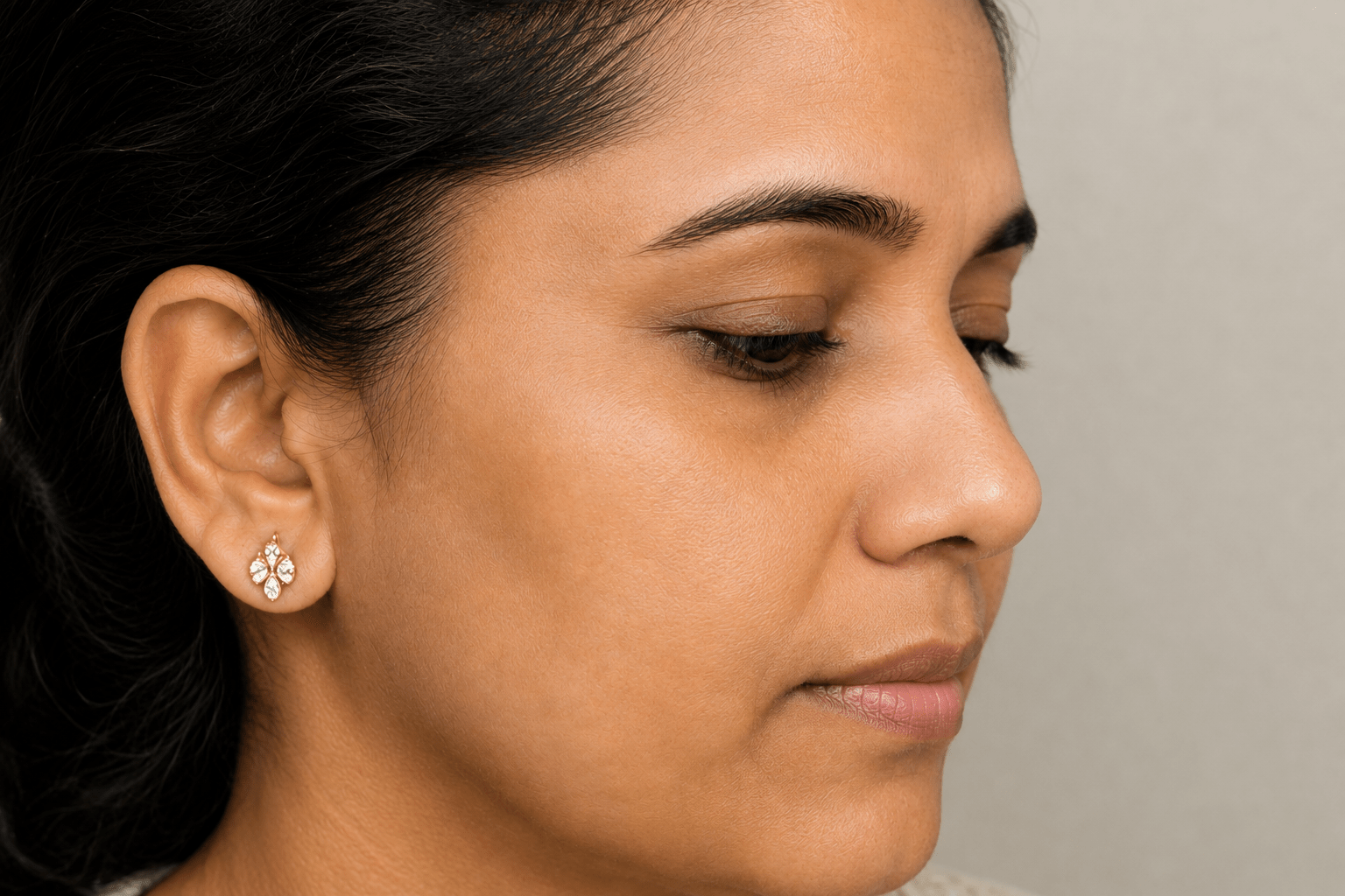 Melasma After